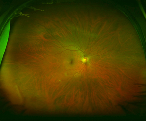 retinal examination